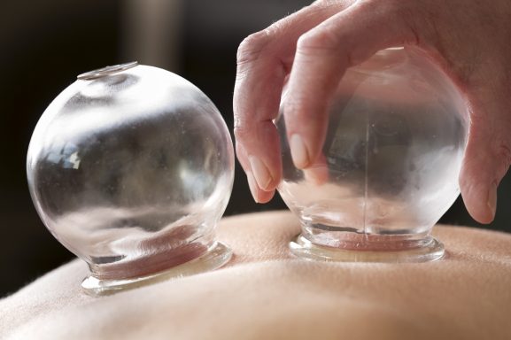 Technique de ventouses sur le dos, avec des boules en verre transparent.